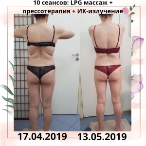 Фотография LPG массажа VESNA 3