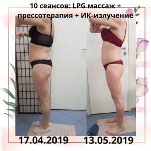 Фотография LPG массажа VESNA 4