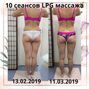 Фотография LPG массажа VESNA 0