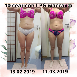 Фотография LPG массажа VESNA 2