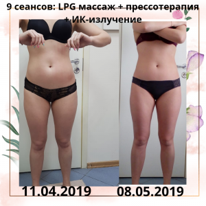 Фотография LPG массажа VESNA 5