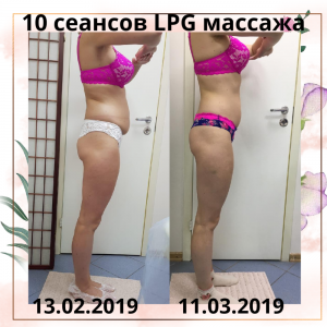 Фотография LPG массажа VESNA 1